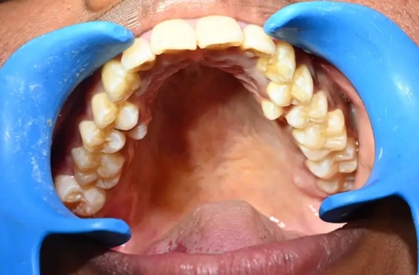 У девушки из Индии рекордное число зубов