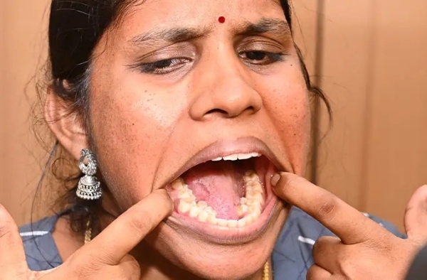 У девушки из Индии рекордное число зубов