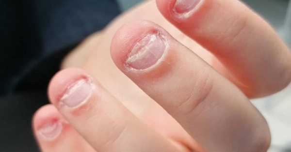 Почему люди кусают ногти?